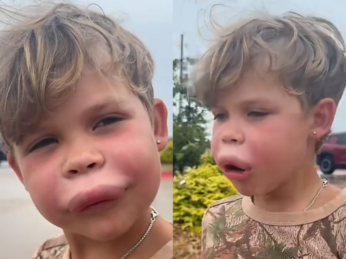 Menino é picado por vespa e reage com tranquilidade ao ver lábio inchado