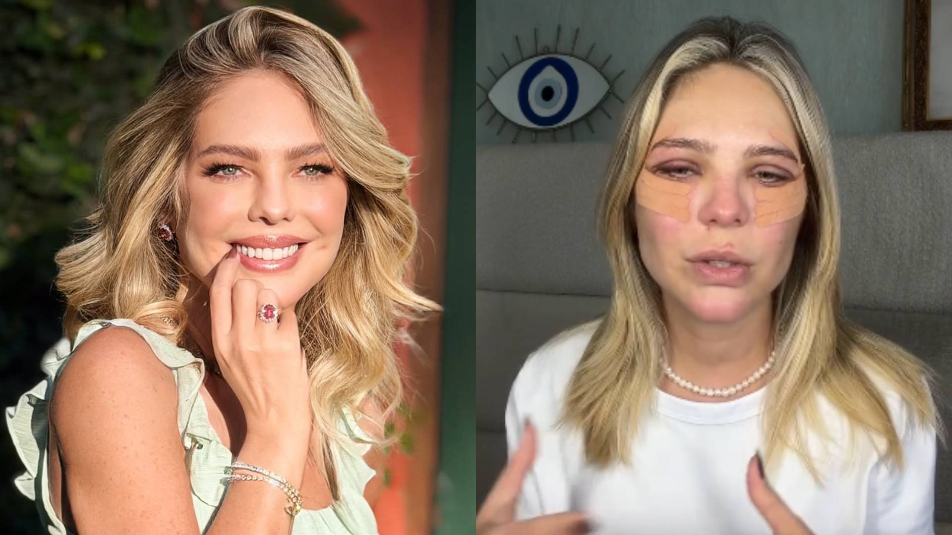 Nora de Leonardo, Thais Gebelein faz cirurgia no rosto e mostra evolução da recuperação